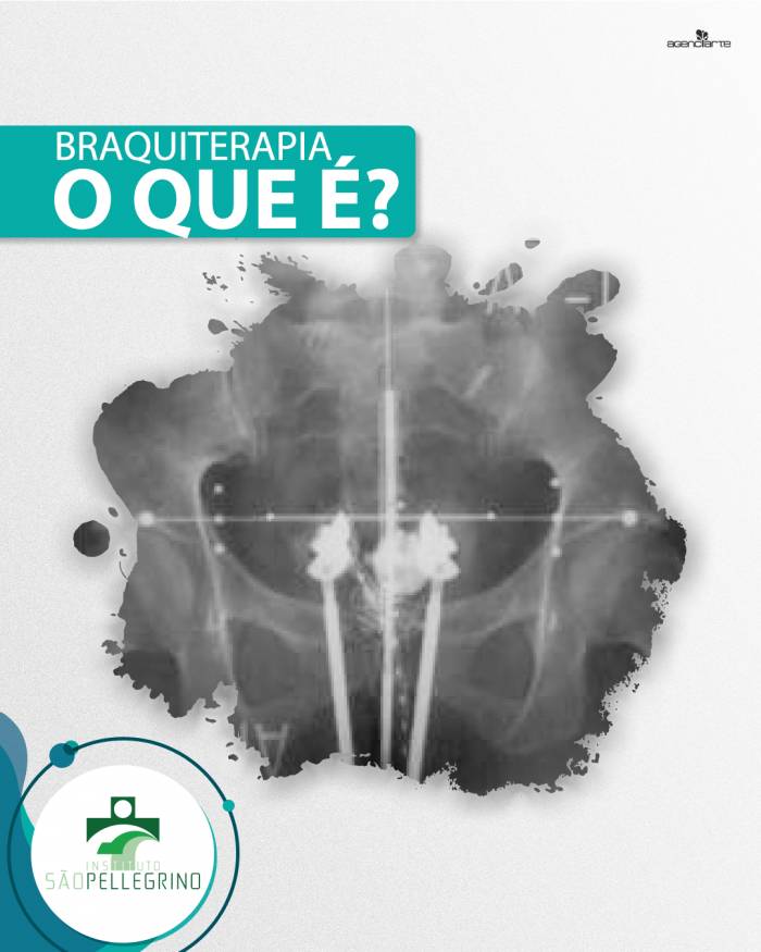 Braquiterapia, o que é?