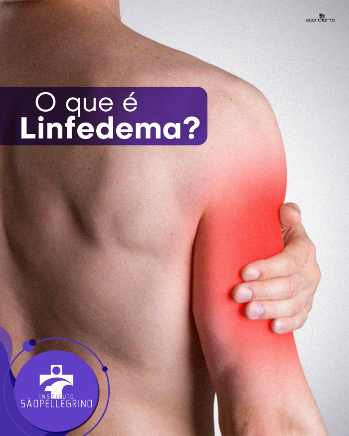 O que é Linfedema?