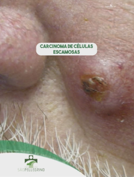CARCINOMA DE CÉLULAS ESCAMOSAS