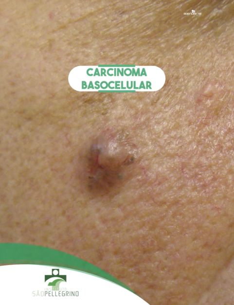 Carcinoma Basocelular