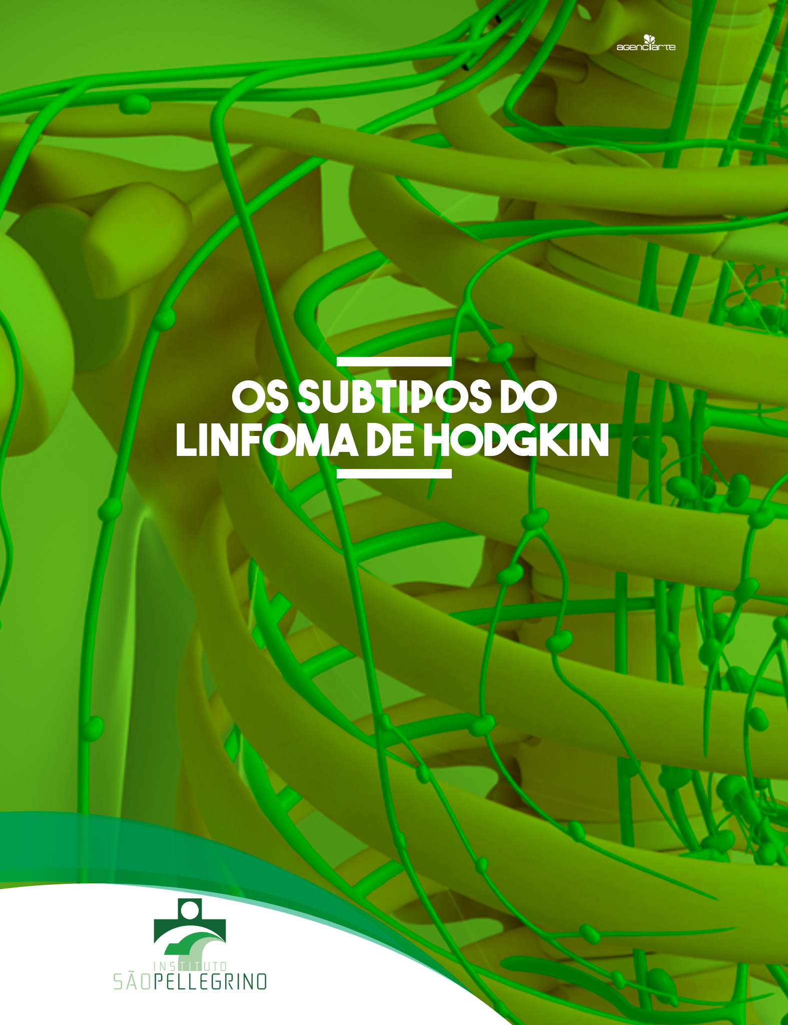 Os subtipos de linfoma de Hodgkin clássico incluem