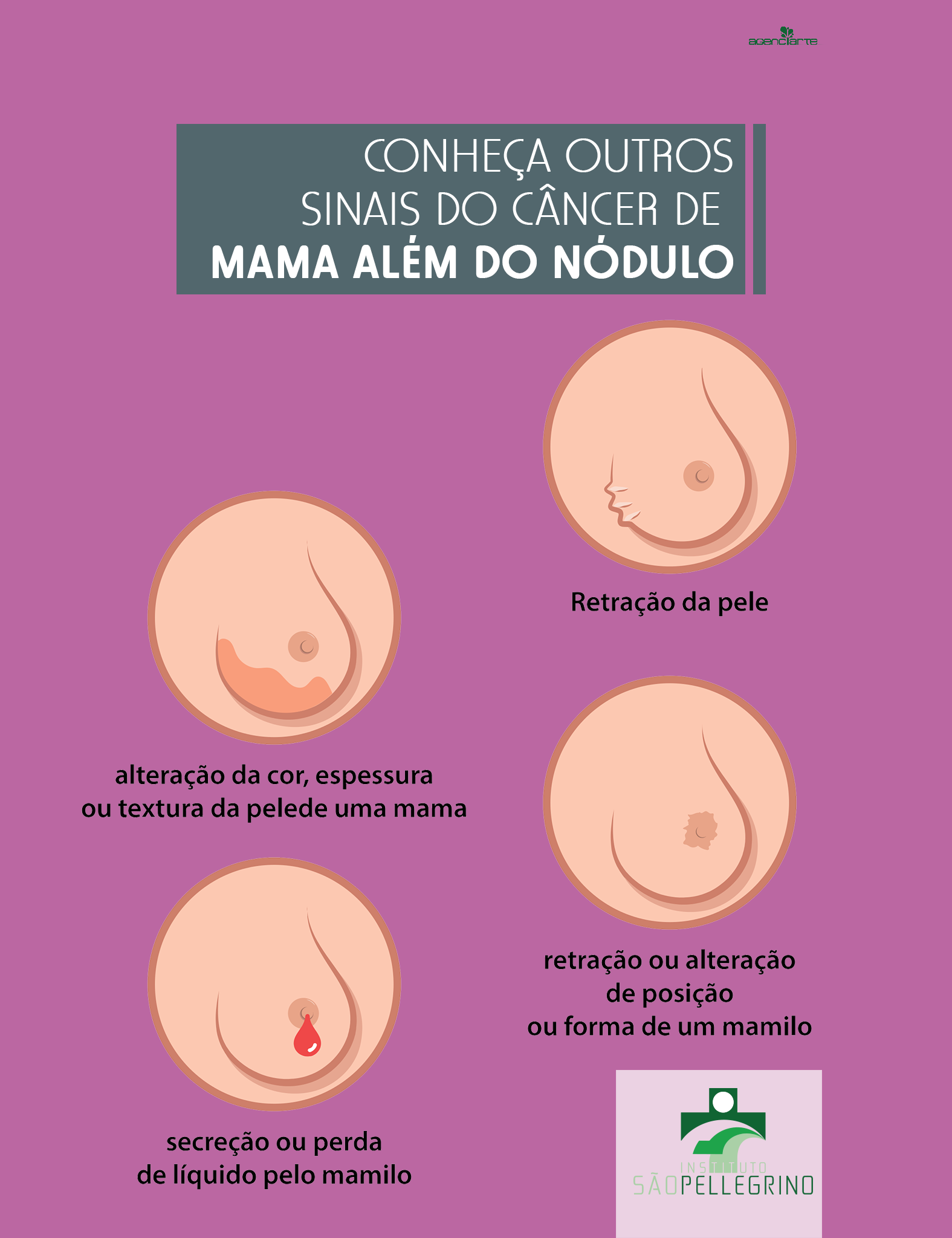 SINAIS DO CÂNCER DE MAMA